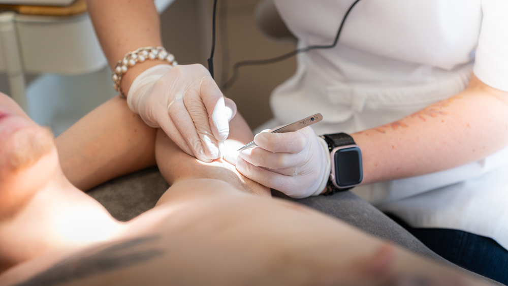 Elektroepilation, die beste Methode zur permanenten Haarentfernung
