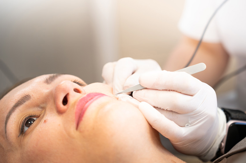 Elektroepilation Kosten